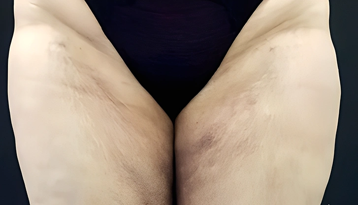 Thigh lift treatment - body contouring after results