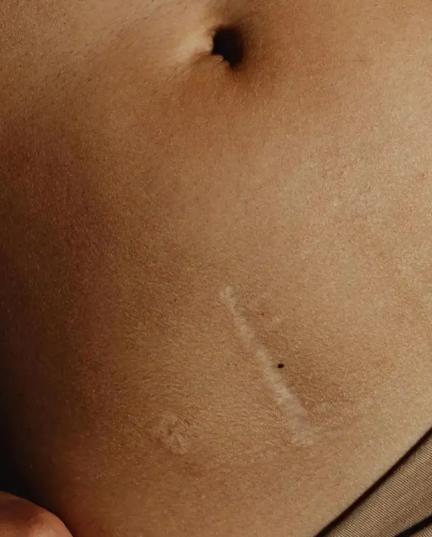 Types of scar revision surgery for scar removal treatment in Dubai