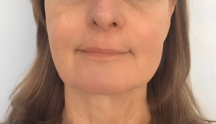 Improved facial contours and firmer skin appearance following a professional Ultherapy session at Halcyon Aesthetics clinic.