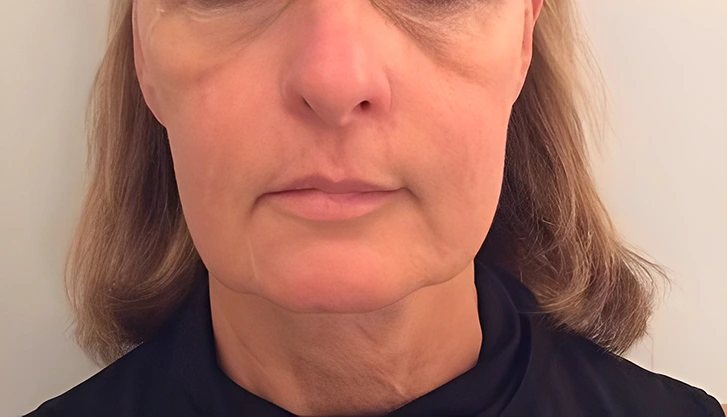 Before Ultherapy skin tightening treatment highlighting loose skin and ageing signs on the face.