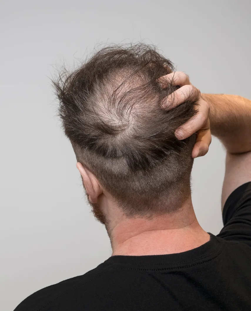 Who Is a Good Candidate for hair therapy